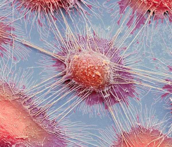ΗΠΑ: Επιστήμονες κατέστρεψαν το 99% των καρκινικών κυττάρων στο εργαστήριο
